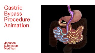 Gastric Bypass Procedure Animation  JampJ MedTech [upl. by Azitram]