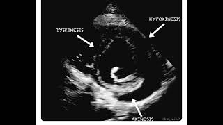 Hypokinesia Dyskinesia and Akinesia in a Single Echocardiography Frame [upl. by Kokoruda]