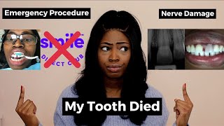 Losing My Tooth  Smile Direct Club Review [upl. by Peedus312]