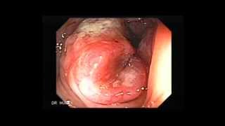 Colonoscopy of Colon Cancer [upl. by Silvio287]