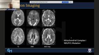 Radiological Diagnosis and Approach to Leukodystrophies [upl. by Crispas]