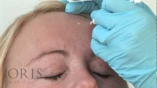 Botox Training  Frontalis  Oris Medical [upl. by Cecily]