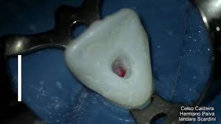 Endodontia Cirurgia de acesso Incisivo Central Superior [upl. by Bolton130]