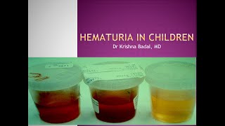 Hematuria in children [upl. by Norvin]