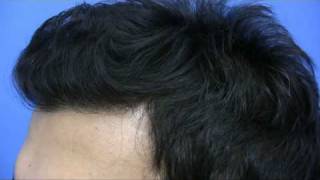 Dr Hasson  Repair to FUE and Hair Transplant [upl. by Reppart]