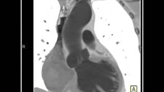 Cardiac Dilated aortic root and sinuses of Valsalva 3 of 10 [upl. by Atazroglam]