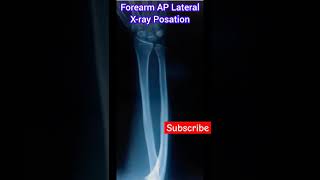 Forearm AP Lateral View Posatin shorts viral medical student collage support me [upl. by Pittel]