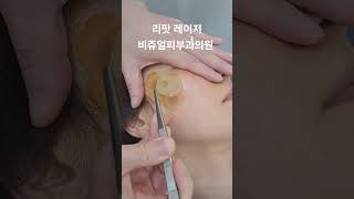 리팟 레이저 다발성 흑자 세종리팟 세종시리팟 reepot lentigo multiplelentigo 청주리팟 공주리팟 대전리팟 오창리팟 오송리팟 부여리팟 [upl. by Llehcsreh439]