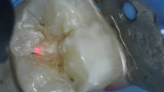 Caries Laser Ablation [upl. by Nevada]