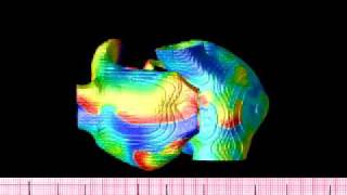 Atrial fibrillation simulation in an anatomical human atria [upl. by Annauqahs208]