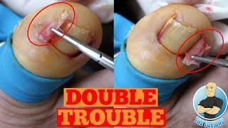 DOUBLE INGROWN TOENAIL REMOVAL FOREVERToe Nail Surgery by The Toe Bro [upl. by Hauhsoj862]