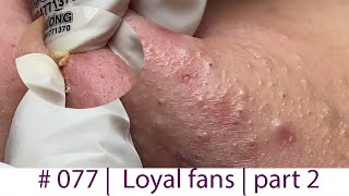 Acne Treatment Huong Da Nang 077  Loyal fans  part 2 [upl. by Millan394]