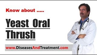 Yeast Oral Thrush  Causes Diagnosis Symptoms Treatment Prognosis [upl. by Lodge]