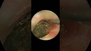 Deep And Stony HARD Earwax Removal Very Satisfying Video [upl. by Oyam]