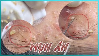 Big Cystic Acne Blackheads Extraction Blackheads amp Milia Whiteheads Removal Pimple Popping [upl. by Hareema308]