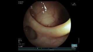 Colonic Diverticulosis [upl. by Pomfrey]