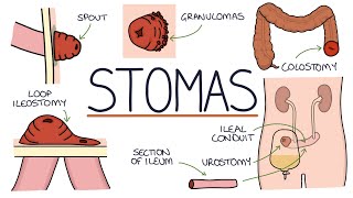 Understanding Stomas Colostomy Ileostomy Urostomy and Gastrostomy [upl. by Deck]