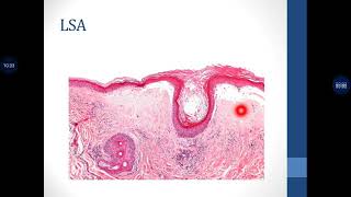 Basic Dermatopathology 8 Interface  Vacuolar [upl. by Egag242]