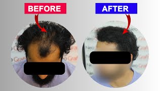 गंजेपन से छुटकारा  Neo Dht Hair Transplant In Chandigarh  hairtransplant neodht [upl. by Watters847]