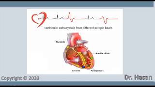 Extrasystole  Premature contraction  atrial nodal and ventricular extrasystole [upl. by Katti629]