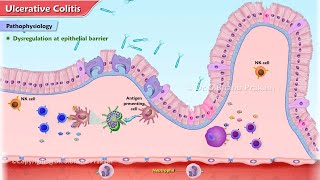 Ulcerative Colitis Animation  Etiology Clinical features Pathophysiology Diagnosis Treatment [upl. by Htessil]