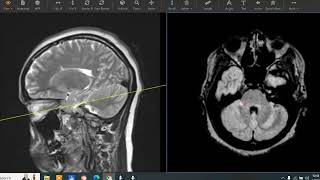 27 year old with extremity weakness and numbness [upl. by Carleton128]