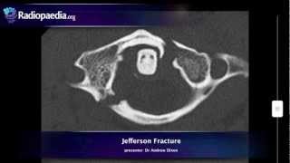 Jefferson fracture  radiology video tutorial xray CT [upl. by Ydnem404]