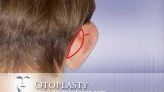 Otoplasty Ear Pinning at wwwPearsonFacescom [upl. by Errehs]