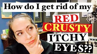 Blepharitis  2 Easy steps to banish red crusty itchy eyes  The Eye Surgeon [upl. by Eelsel497]