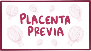 Placenta previa  causes symptoms diagnosis treatment pathology [upl. by Grethel804]