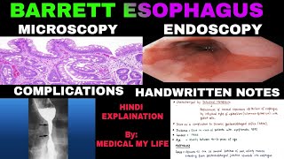 Barretts Esophagus  Pathology [upl. by Lebbie]