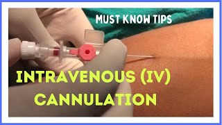 INTRAVENOUS IV CANNULATION in 5 mins How to insert [upl. by Efi]