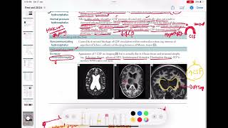 ex vacuo ventriculomegaly neurology 104  First Aid USMLE Step 1 in UrduHindi [upl. by Bibby]