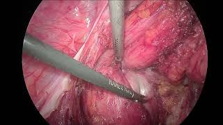 Laparoscopic Excision of a sacrococcygeal teratoma [upl. by Etsirk]