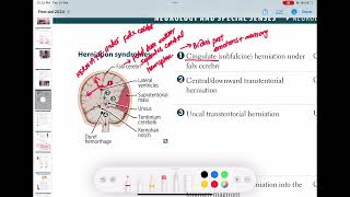 Cingulate herniation neurology 148  First Aid USMLE Step 1 in UrduHindi [upl. by Einniw358]