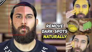 6 WAYS TO REMOVE DARK SPOTS  Black Spots Hyper Pigmentation amp Acne Scars  Home Remedies [upl. by Pettifer]