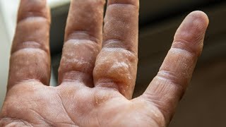 Dyshidrotic Eczema What Is Dyshidrotic Eczema [upl. by Anaynek]