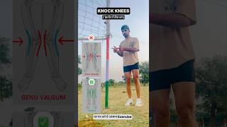 KNOCK KNEES WORD 🌎 BEST ✅ EXERCISE 👀💯 fitnesstips [upl. by Lola]