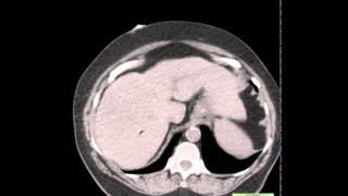 CT Epiploic Appendagitis [upl. by Appolonia]