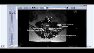 Rezonans magnetyczny kręgosłupa lędźwiowego anatomia i patologia podstawy [upl. by Suoirred]