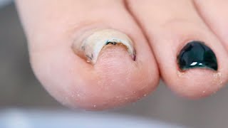 Super CURVED INGROWN Toenail PLUS NAIL REMOVAL [upl. by Haibot]