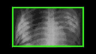 Symptome der Tracheobronchitis [upl. by Resa]