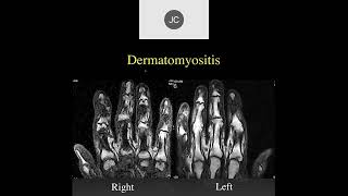 MRI of the Wrist Part 15  Wrist Inflammation [upl. by Aicul]