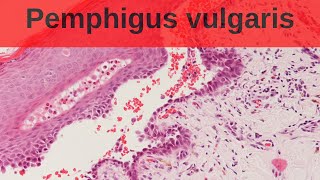 Pemphigus Vulgaris  Pathology mini tutorial [upl. by Remle254]