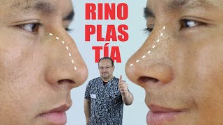 RINOSOFT Caso Real 🙌🏼 RINOPLASTÍA sin Hematomas ni SANGRADO 👃🏼 🤩 DR ALBERTO CALVO QUIROZ [upl. by Nikolos]