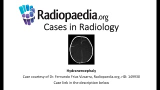 Hydranencephaly Radiopaediaorg Cases in Radiology [upl. by Arianne]