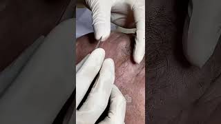 Blackhead Removal for Elderly Woman Gentle and Effective Extraction [upl. by Arabel]