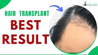 Result Alert  Hair Transplant  Hair Hub prp hairtransplant [upl. by Beckman]