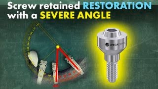 Getting the best out of a poorly placed dental implant using a screw retained restoration [upl. by Huda832]