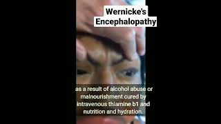 Wernickes Encephalopathy [upl. by Dnama]